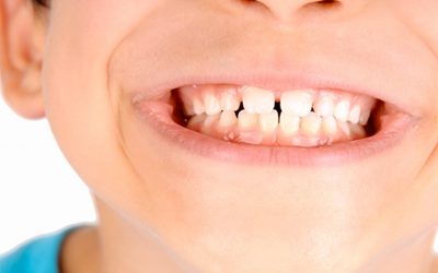 Il fumo degli adulti è nemico dei denti dei bambini