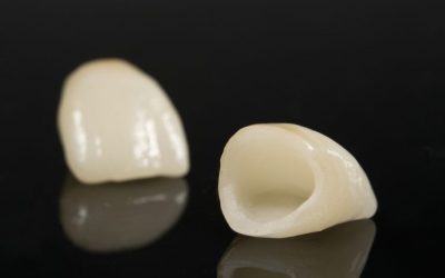 Corona dentale: durata, materiali, vantaggi e costi